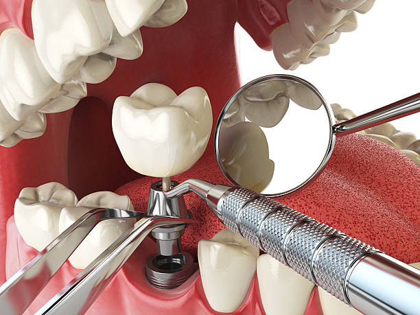 Best Emergency Dentist for Lost Fillings or Crowns in Pecan Grove, TX